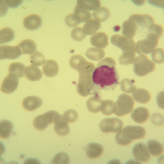 Foto da extensão sanguínea 4