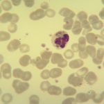 Foto da extensão sanguínea 1