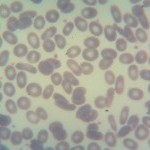 Foto da extensão sanguínea 4