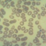 Foto da extensão sanguínea 3